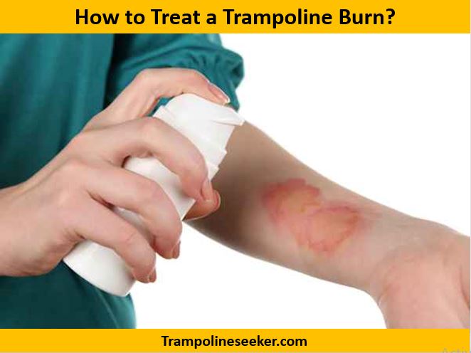 How to Treat a Trampoline Burn